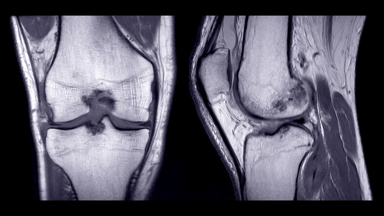 Chronic Joint & Tendon Pain Embolization - Image 4