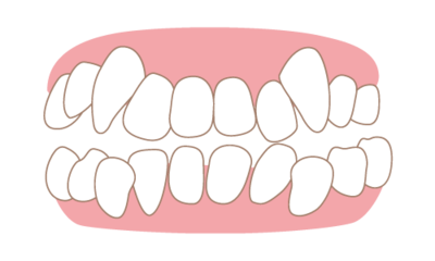 Invisalign