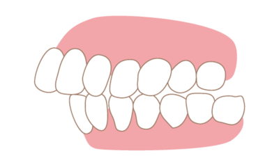 Invisalign