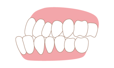 Invisalign