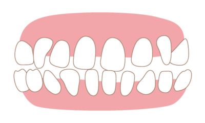 Invisalign