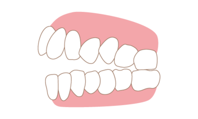 Invisalign