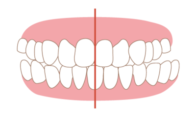 Invisalign
