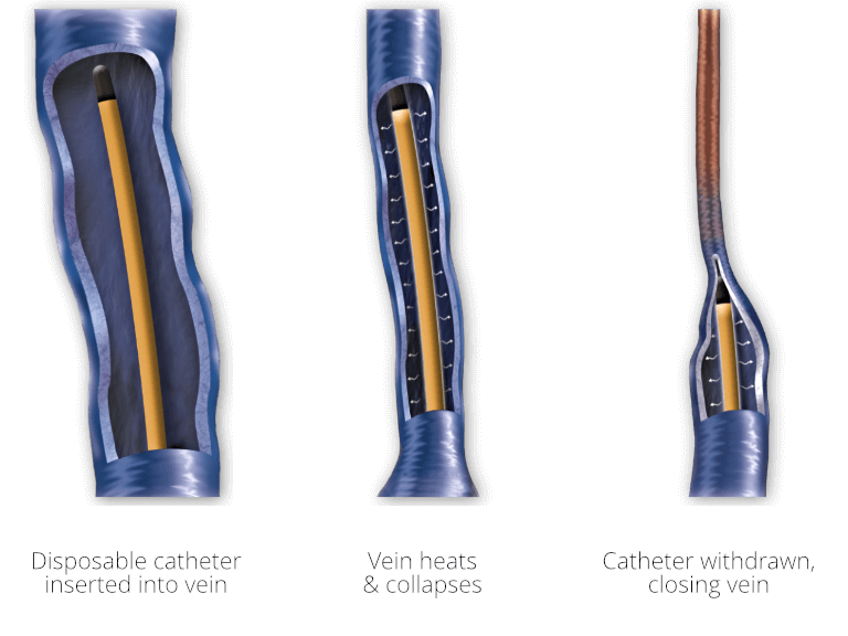 Varicose vein treatment