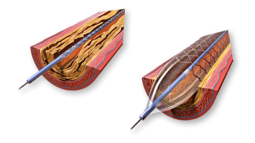 Peripheral arterial disease