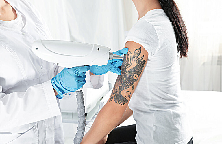 Tattoo Removal
