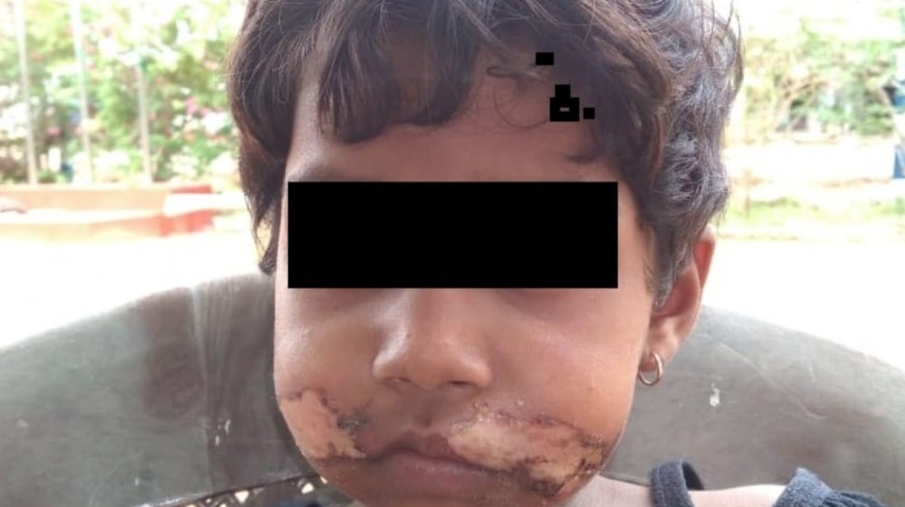 அப்பளத்தை எடுத்து 5வயது சிறுமிக்கு வாயில் சூடுவைத்த தாய்