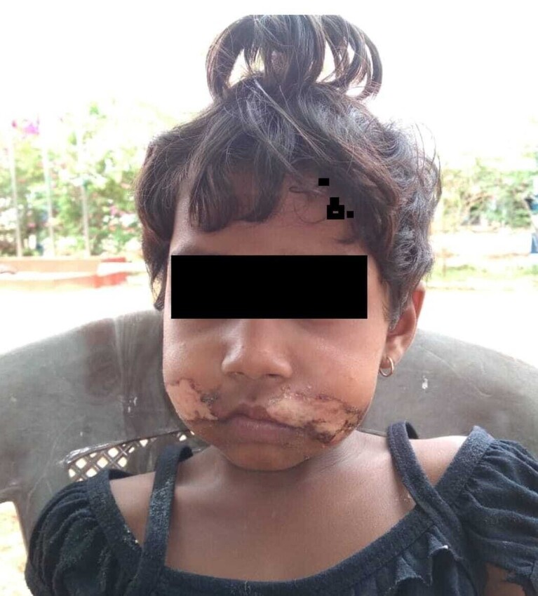 அப்பளத்தை எடுத்து 5வயது சிறுமிக்கு வாயில் சூடுவைத்த தாய்