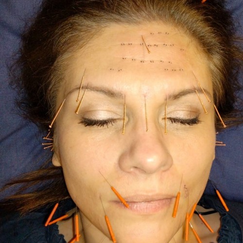 Cosmetic Facial Acupuncture