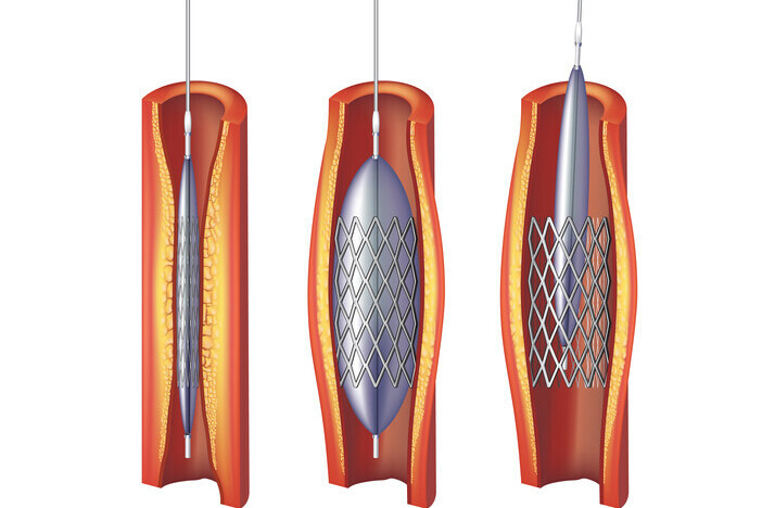 Peripheral Arterial Disease