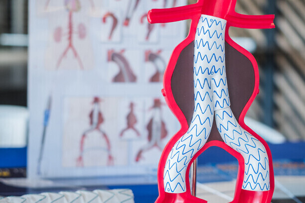 Abdominal Aortic Aneurysms