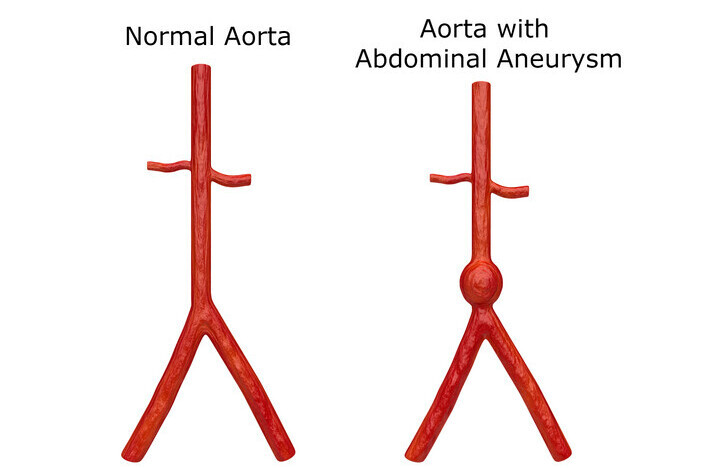 Abdominal Aortic Aneurysms