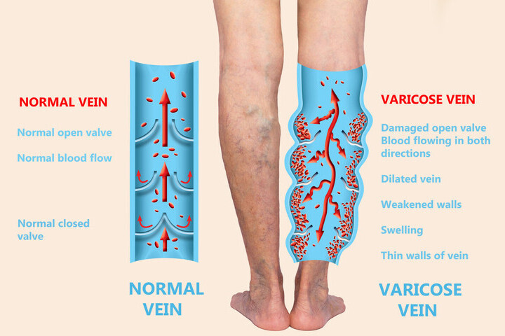 Varicose Veins & Thread Veins