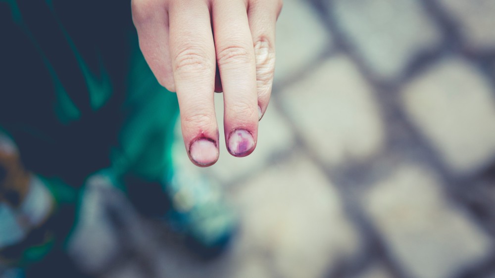 தீப்பற்றி இளம் பெண் காயம்