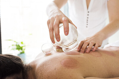 Cupping Therapy