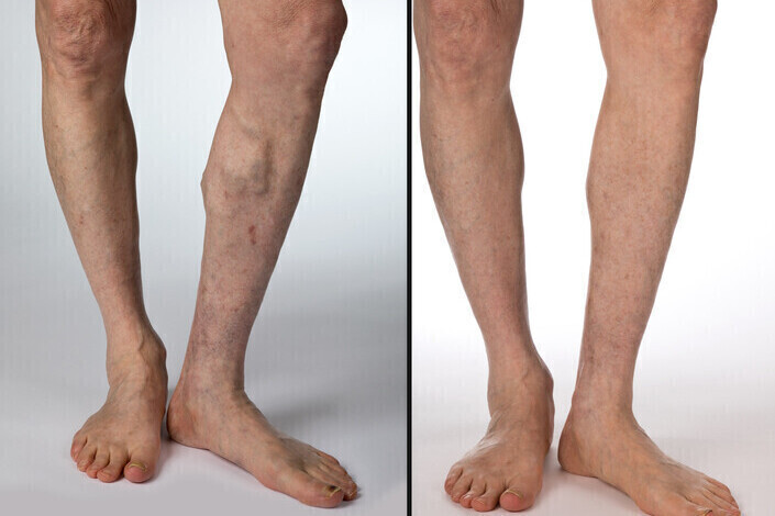 Varicose Veins & Thread Veins