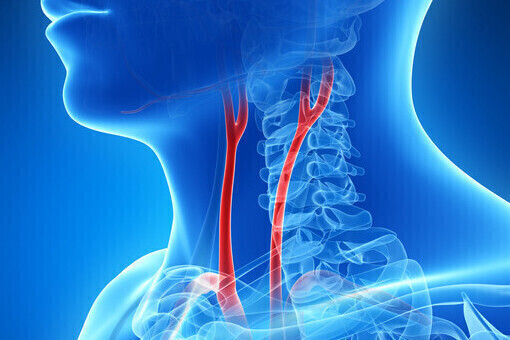 Carotid Artery Disease