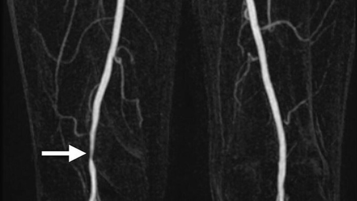 Peripheral Arterial Disease