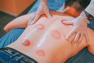 Cupping Therapy