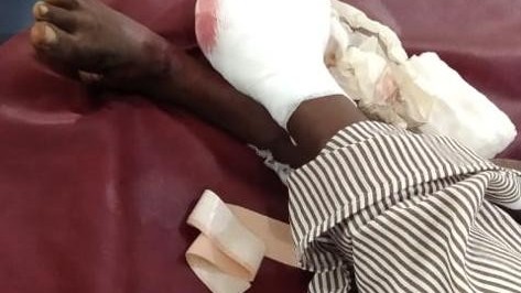 மர்மப் பொருள் வெடித்ததில் படுகாயம் அடைந்த சிறுமி