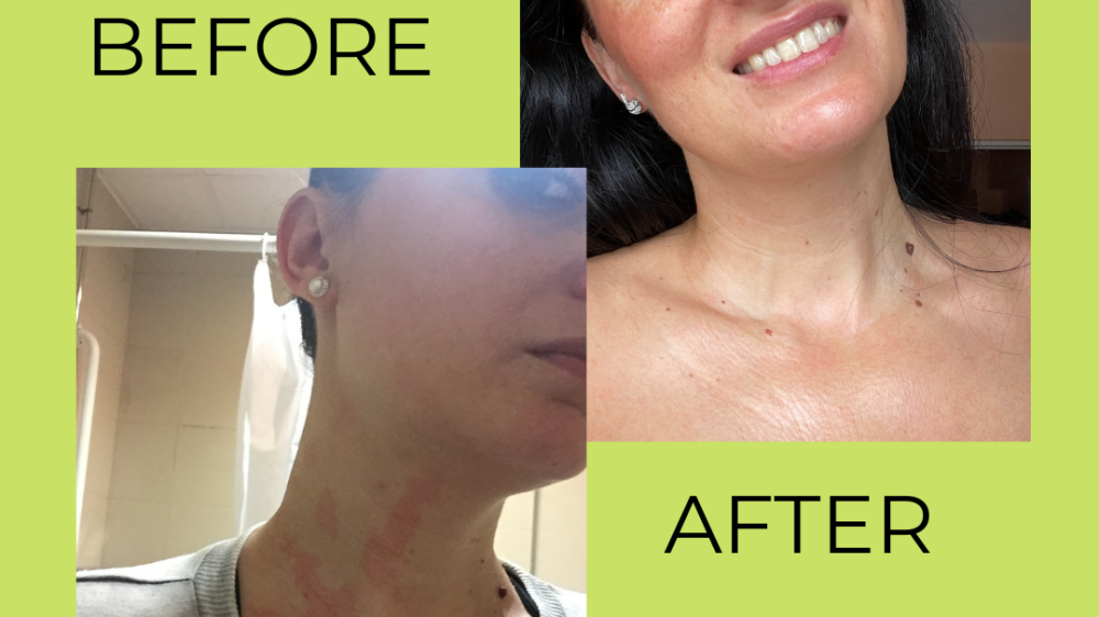 Stool testing for skin issues and allergies