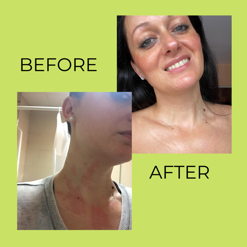 Stool testing for skin issues and allergies