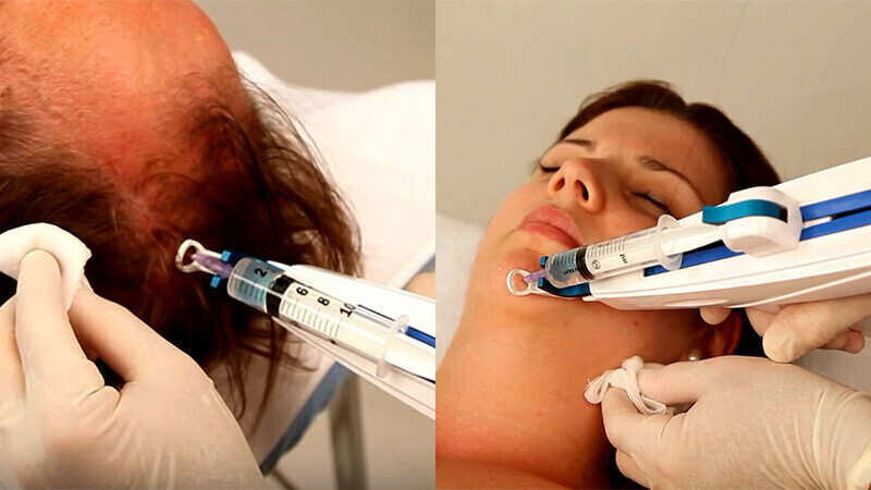 Mesotherapy Treatments