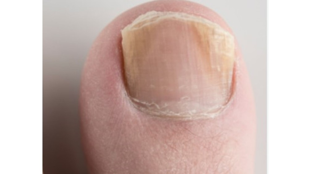 நிகச்சுத்தி (Paronychia) வராமல் தடுக்கும் வழியென்ன?