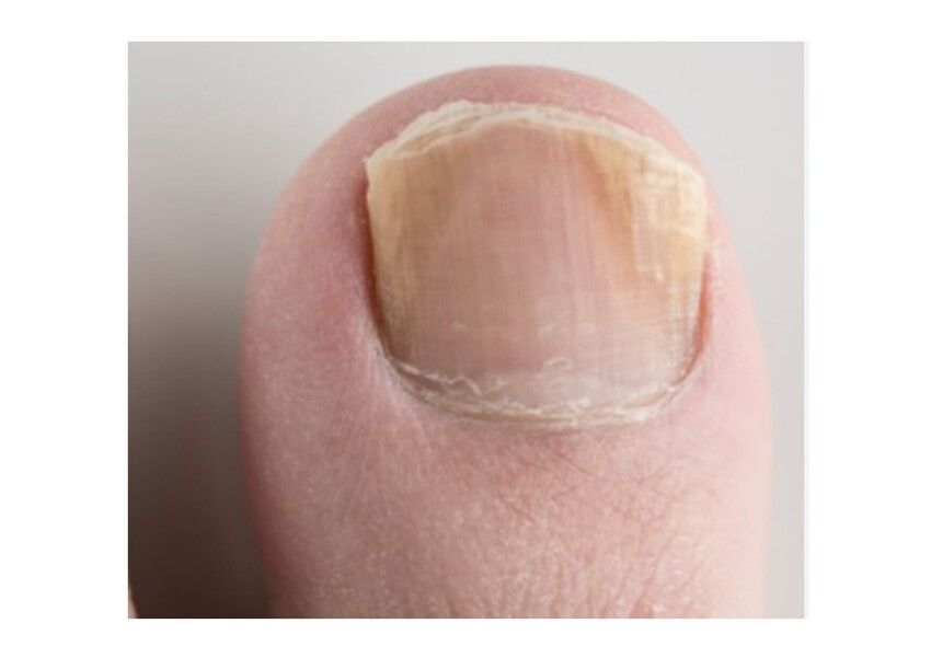 நிகச்சுத்தி (Paronychia) வராமல் தடுக்கும் வழியென்ன?