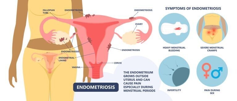 Pelvic Pain and Endometriosis