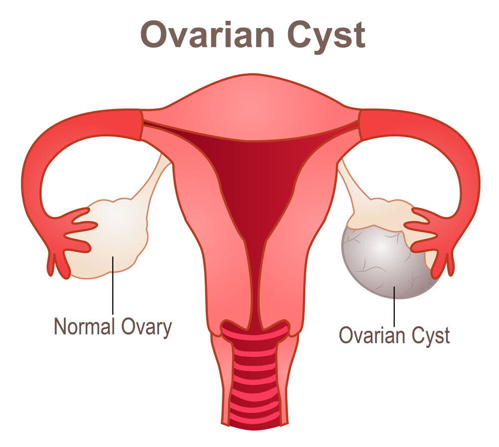 Ovarian Cyst