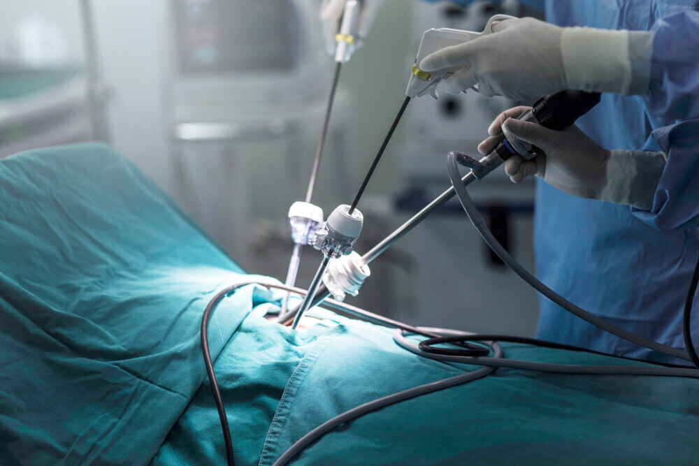 Laparoscopic Excisional Surgery