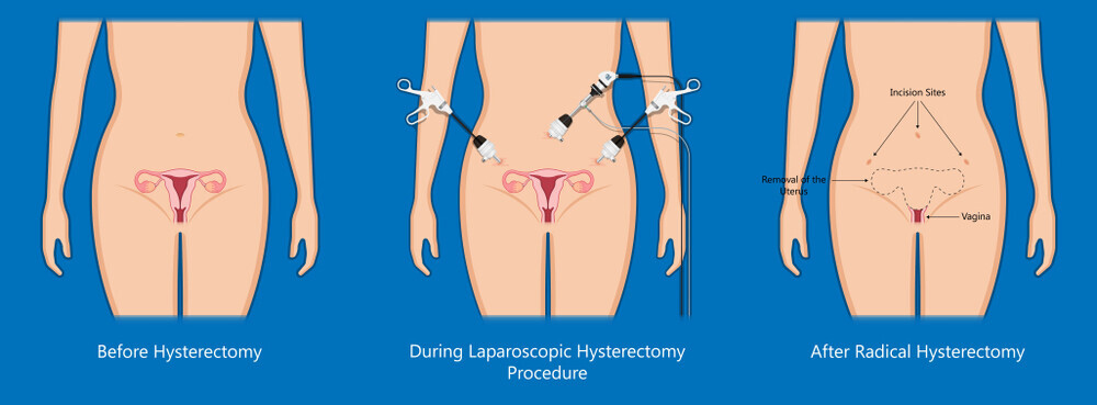Hysterectomy