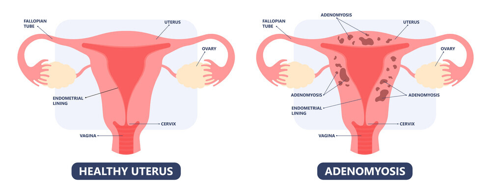 Pelvic Pain and Endometriosis