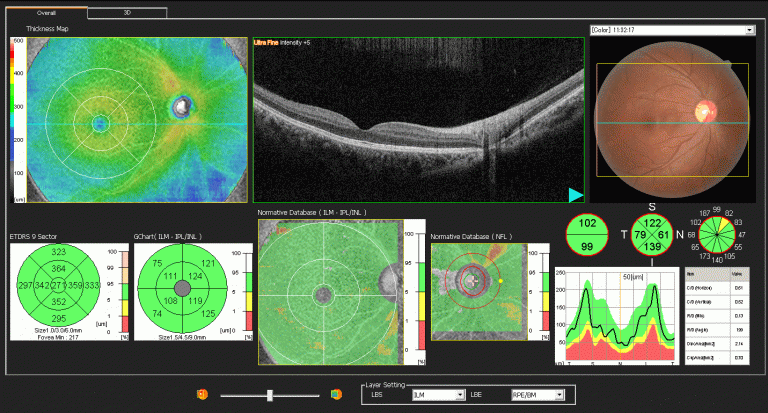 OCT Retina Scan
