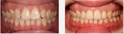 INVISALIGN, invisible, removable braces