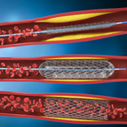 Stent Coating – Dispensing application with Ciposa