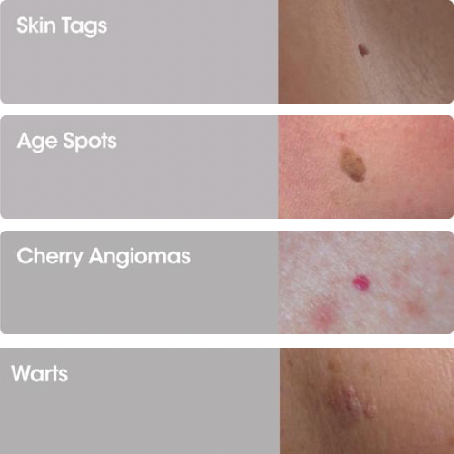 CrayoPen Skin Treatment