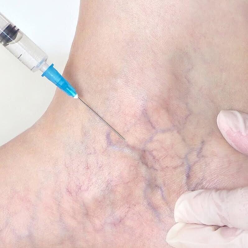 Sclerotherapy