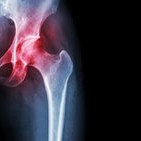The truth about Arthritis