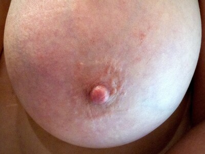 Areola Enhancement