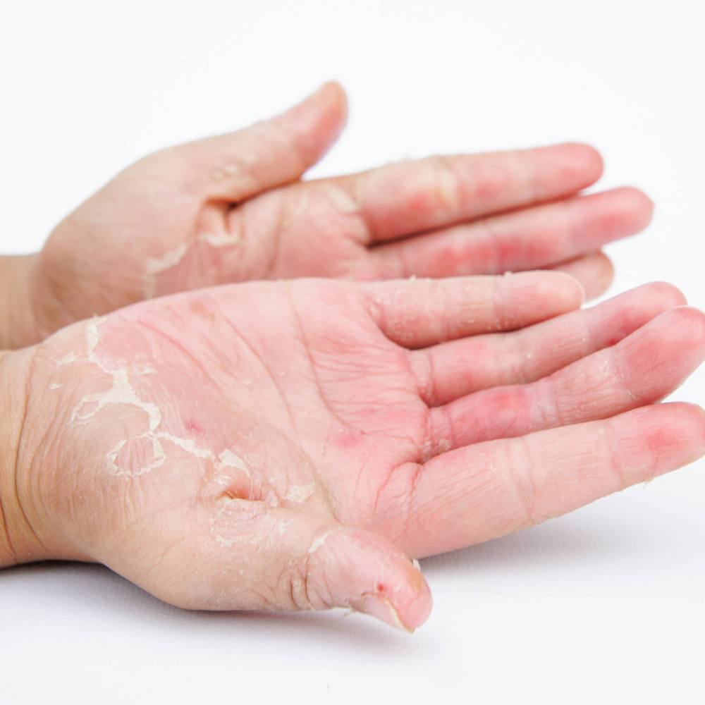 Weathering Eczema: Seasonal Flare-Up Management