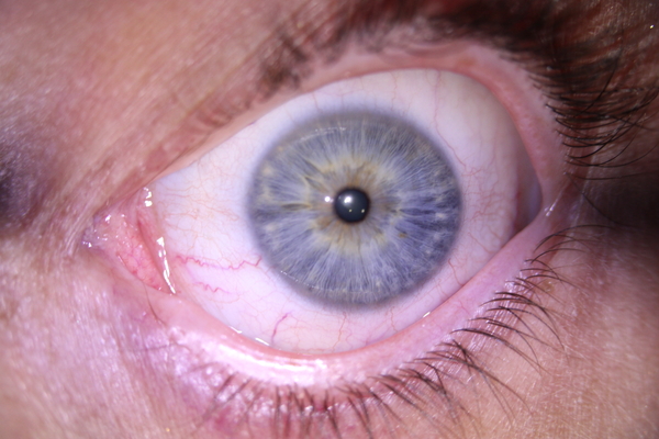 Blue eye Constitution