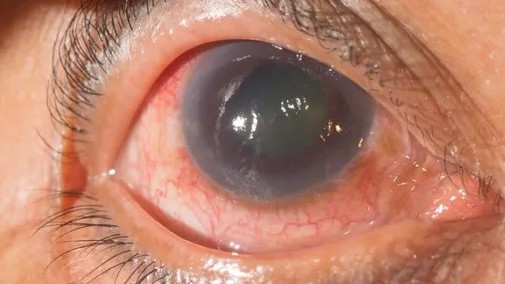 யாழ்ப்பாண மாவட்டத்தில் அதிகரிக்கும் கண் நோய்