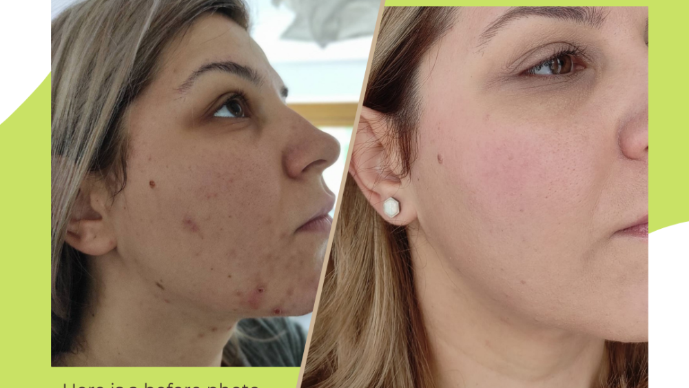 Case Study: Real People's Acne Journeys to Clear Skin