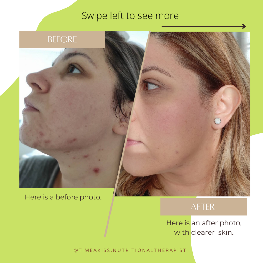 Case Study: Real People's Acne Journeys to Clear Skin