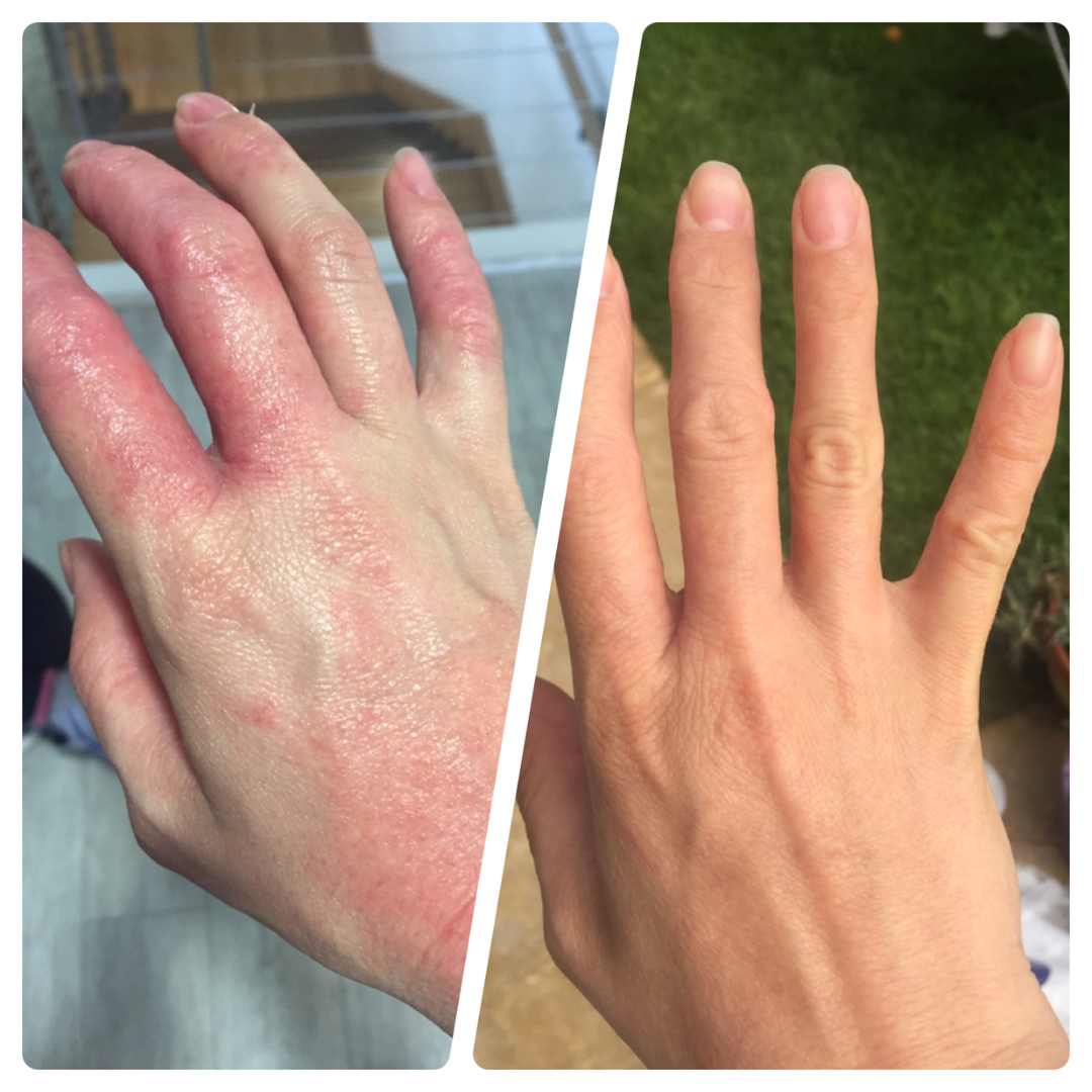  Effective Eczema Relief: A Holistic Approach to Lasting Results