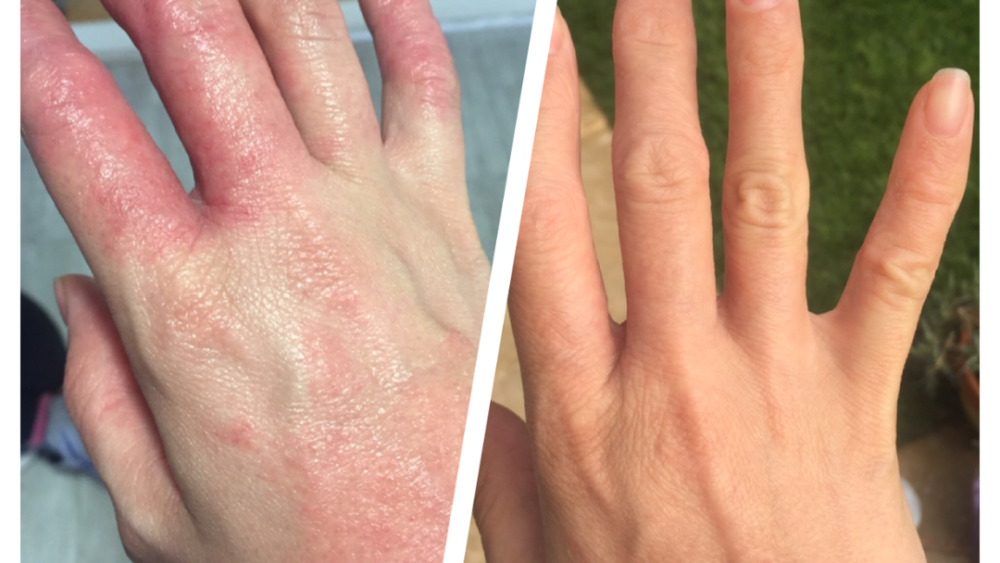  Effective Eczema Relief: A Holistic Approach to Lasting Results