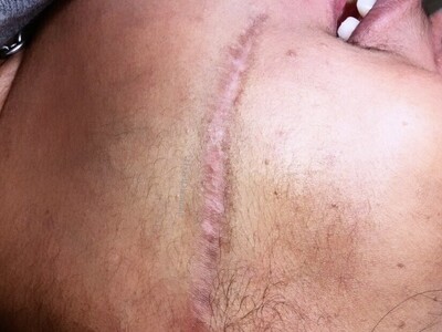 Medical Micropigmentation