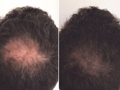Medical Micropigmentation